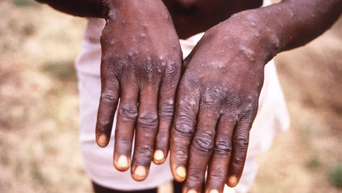 1653391557076_tdy_health_7a_azar_monkeypox_symptoms_220524_1920x1080-s0zy00