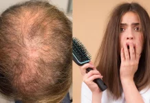 From Cancer to Diabetes, here are five medical conditions that cause hair loss Cause of Hairfall