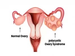 PCOS