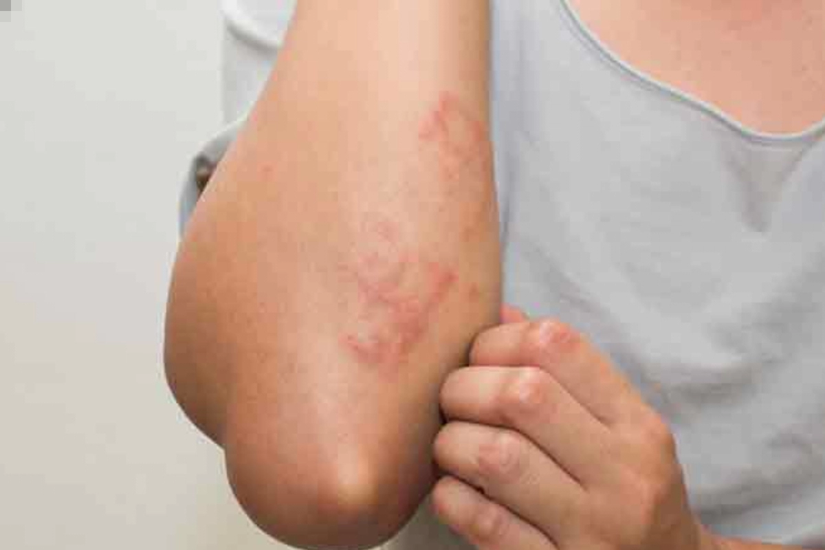 Monsoon skin diseases: From eczema to scabies, tips for prevention