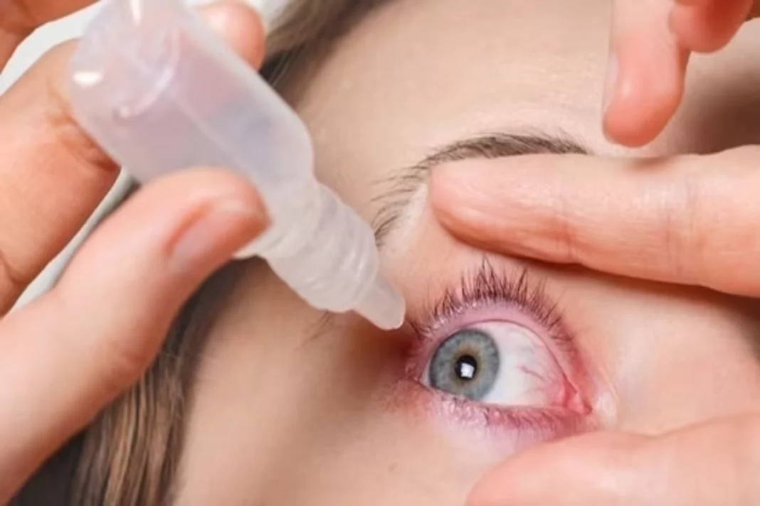 conjunctivitis
