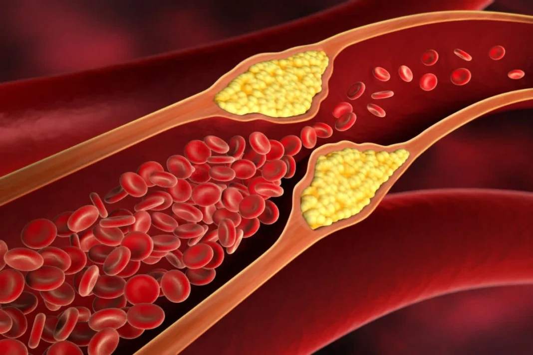 Cholesterol Level