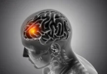 Brain Stroke: What is it? Causes, Symptoms and Precautions Explained Brain Stroke