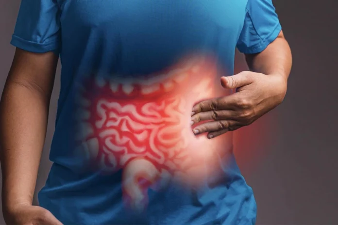 Inflammatory Bowel Disease Inflammatory Bowel Disease