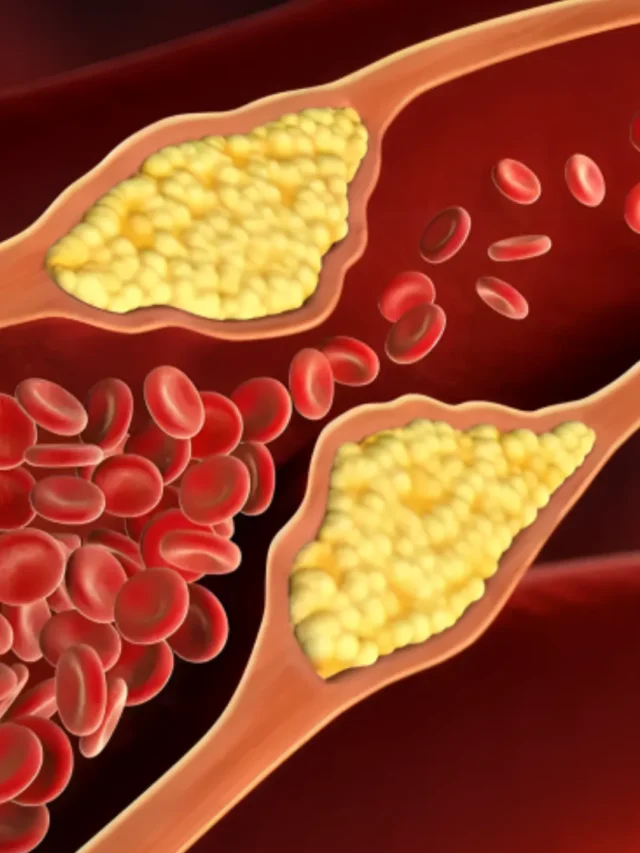 Cholesterol