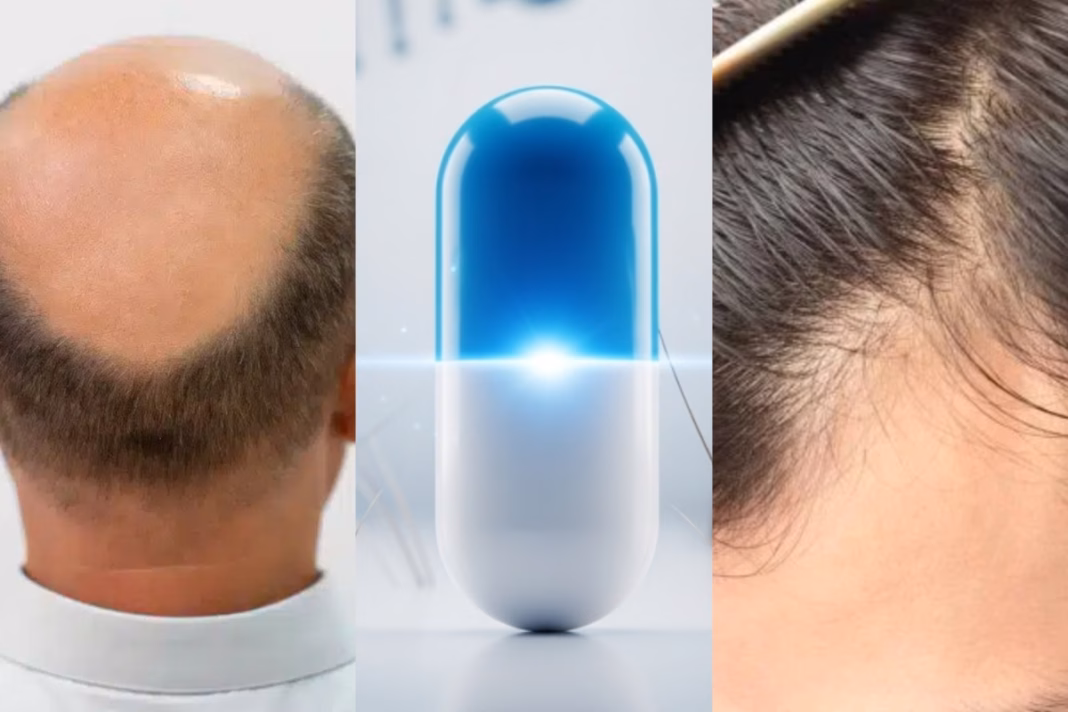 Hair Loss Treatment Forget Transplants, THIS New Drug Could End Baldness Permanently With Quick Results