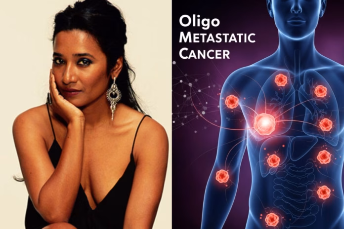 What Is Oligo Metastatic Cancer Tannishtha Chatterjee Is Suffering From