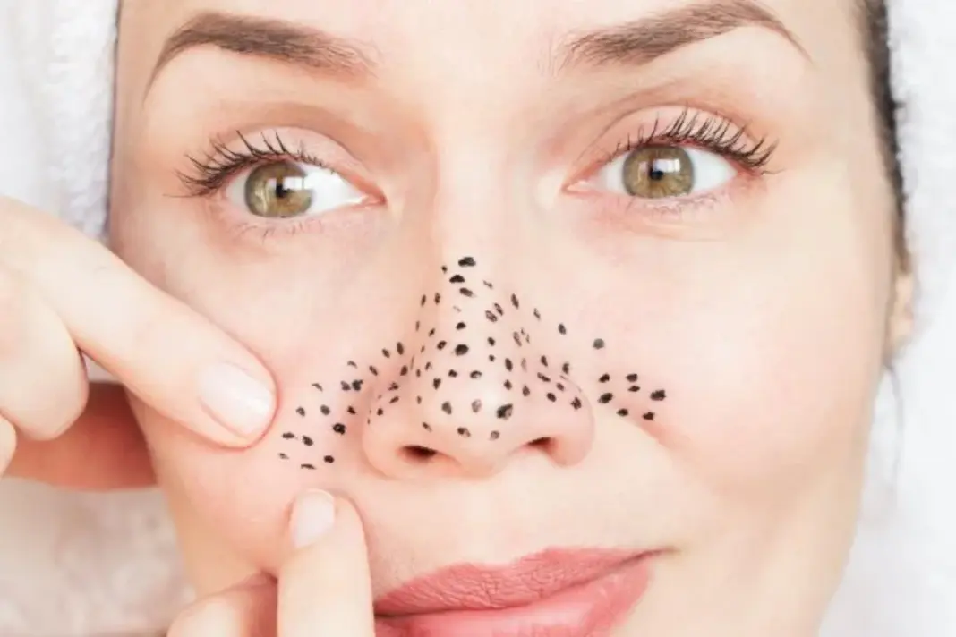 Blackheads