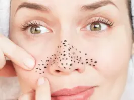 Blackheads
