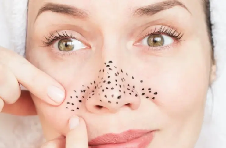 Blackheads