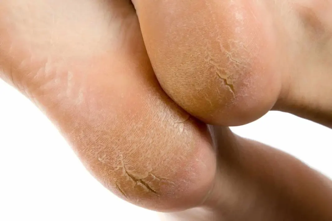 Cracked Heels