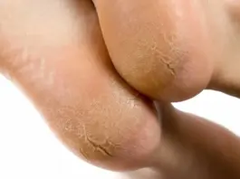 Cracked Heels