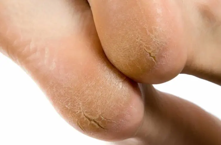 Cracked Heels