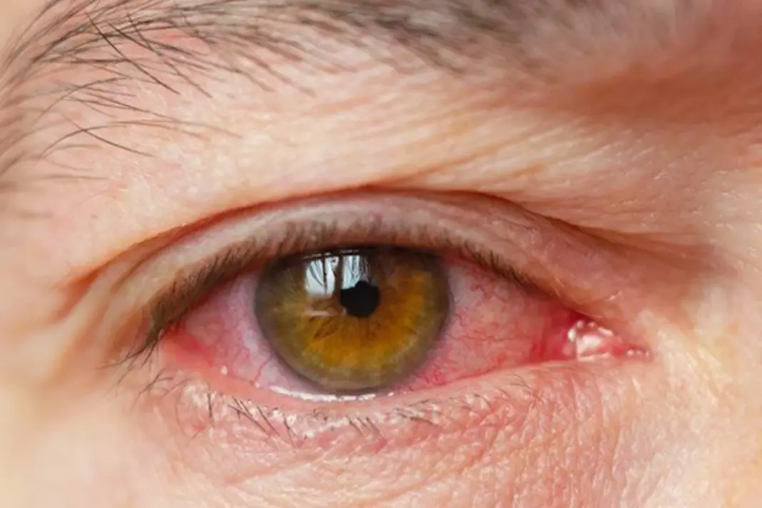 Dry Eyes