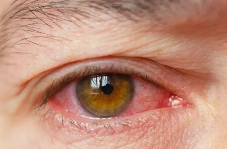 Dry Eyes