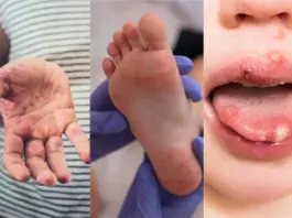 Mouth Disease