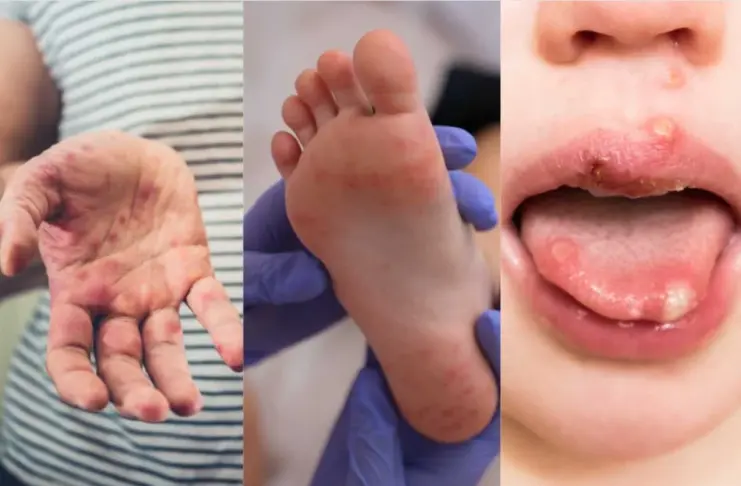 Mouth Disease