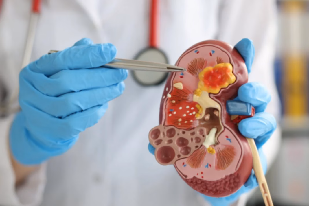 Kidney Cancer