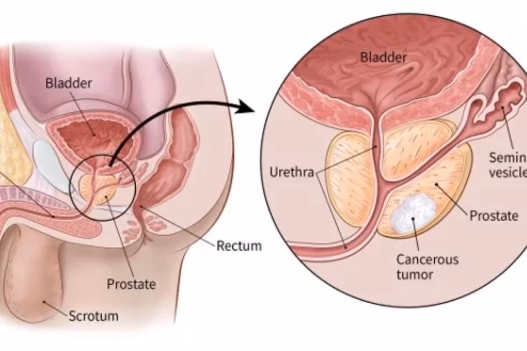 Prostate Cancer