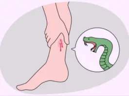 Snake Bite - What To Do