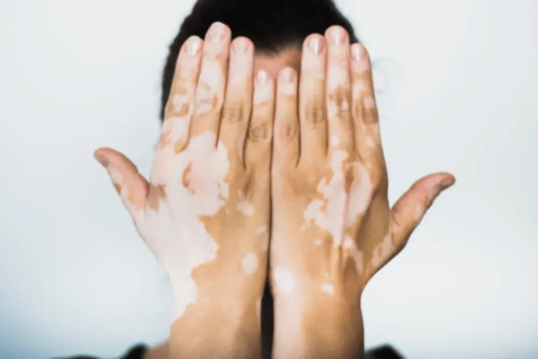 White Patches on Skin