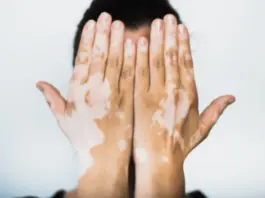 White Patches on Skin