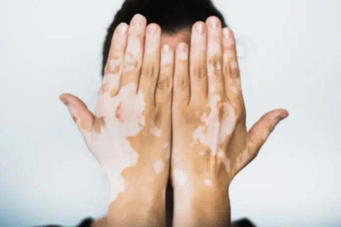White Patches on Skin