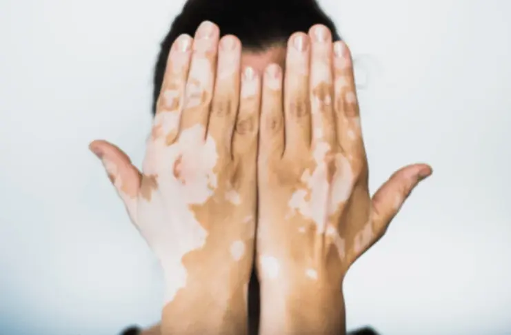 White Patches on Skin
