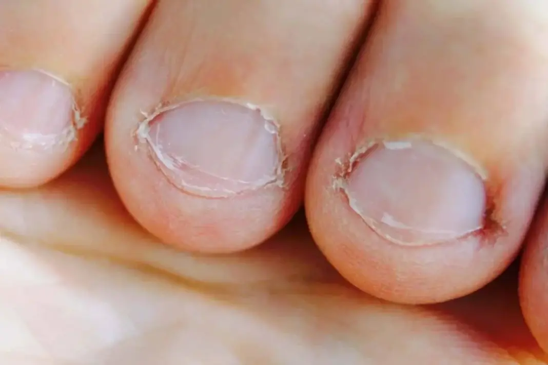 Nail Health