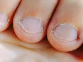 Nail Health