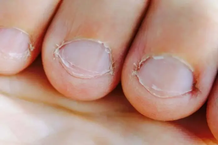 Nail Health Nail Health