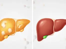 Reverse Fatty Liver