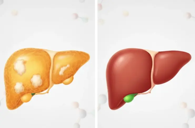 Reverse Fatty Liver