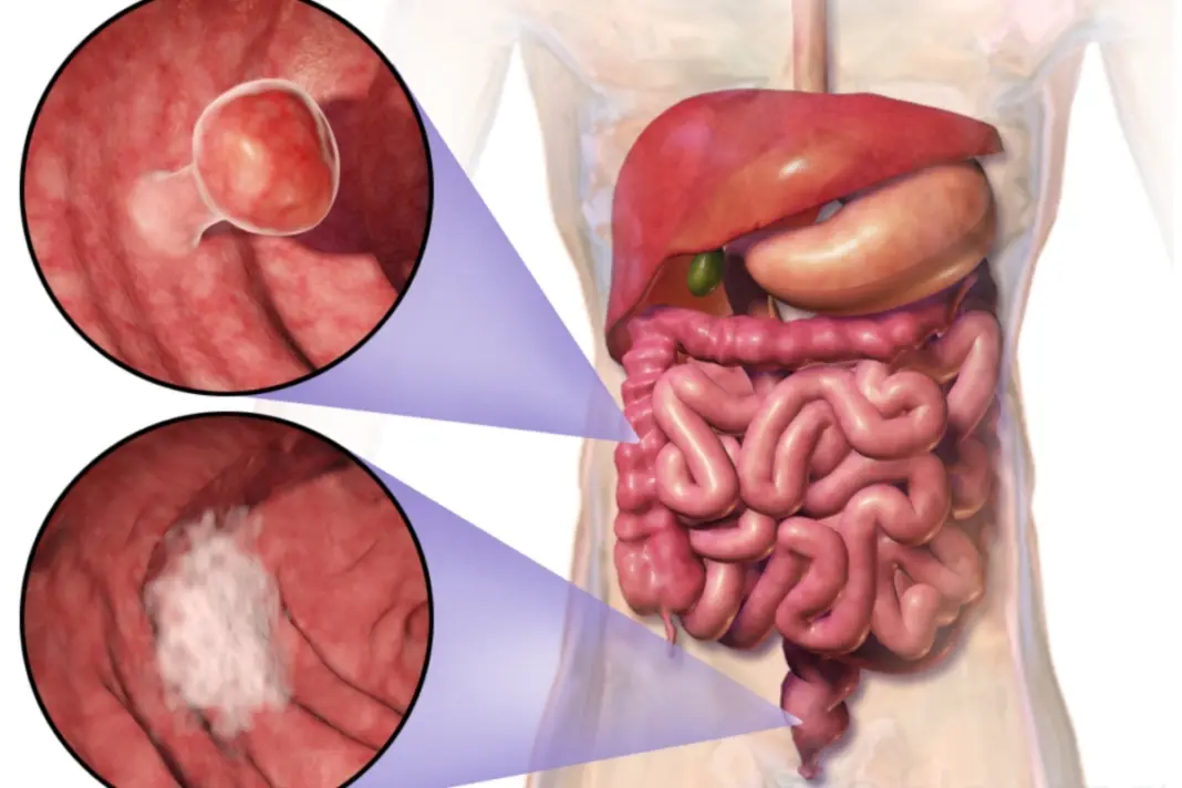 Colorectal Cancer Rising Among Young People
