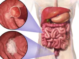 Colorectal Cancer Rising Among Young People
