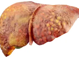 Liver Cirrhosis