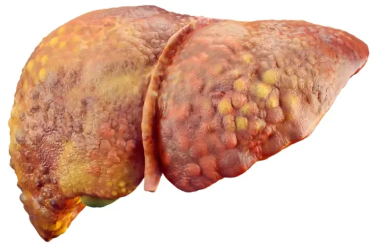 Liver Cirrhosis