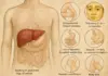 What’s the End Stage of Fatty Liver Disease, Are You Heading Towards It? Check Symptoms fatty liver disease