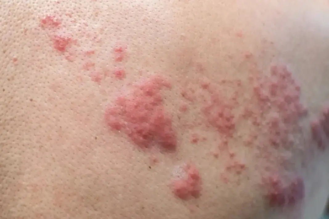 This Skin Rash Could Be Dangerous Zoster Virus