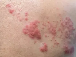This Skin Rash Could Be Dangerous Zoster Virus