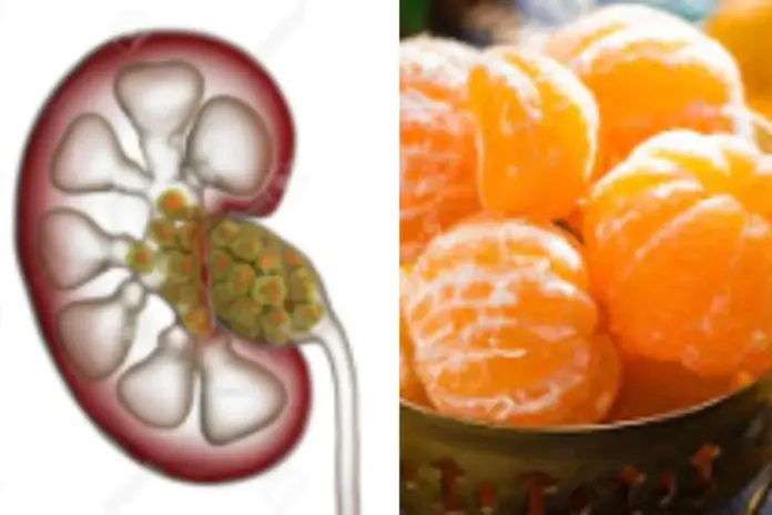 Kidney Stone Kidney Stone