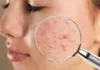 Pimple Home Remedies: Indian Actress Shares 4 Natural Tricks That Help Calm Painful Acne Fast, Check Video