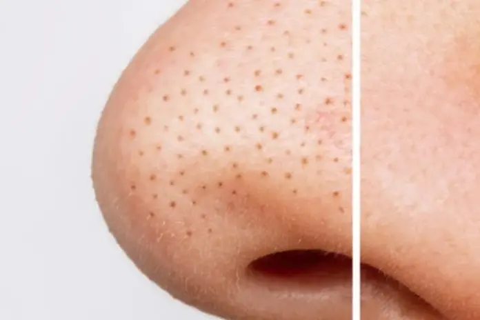blackhead removal blackhead removal