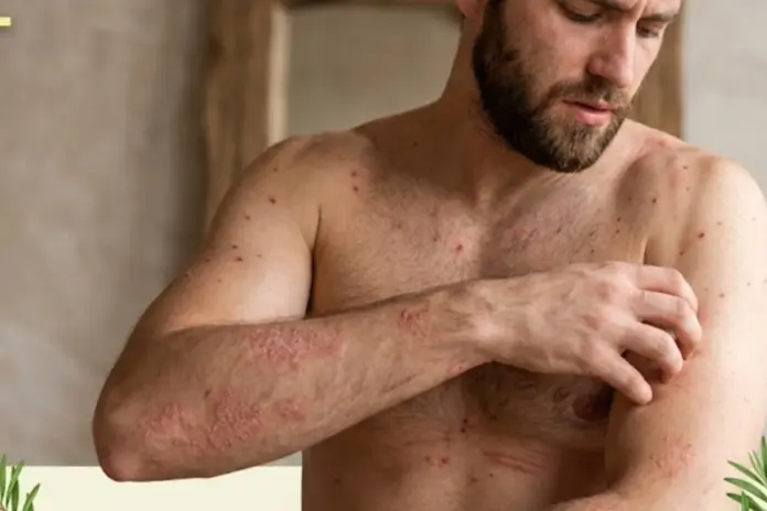 Ayurvedic Skin Remedy 4 Herbs That Can End Itching, Acne And Fungal Infections Fast