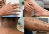 Diabetes Can Disguise Itself As Skin Changes – Doctor Deciphers 13 Rare But Critical Indicators Diabetes Warning Signs by Skin