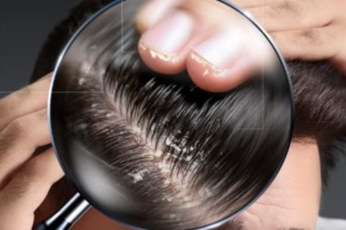 Oily Scalp