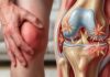 High Uric Acid Warning: Doctor Explains Silent ‘Crystal Build-Up’ Behind Joint Pain – Simple Remedy Shared! High Uric Acid Joint Pain Remedy