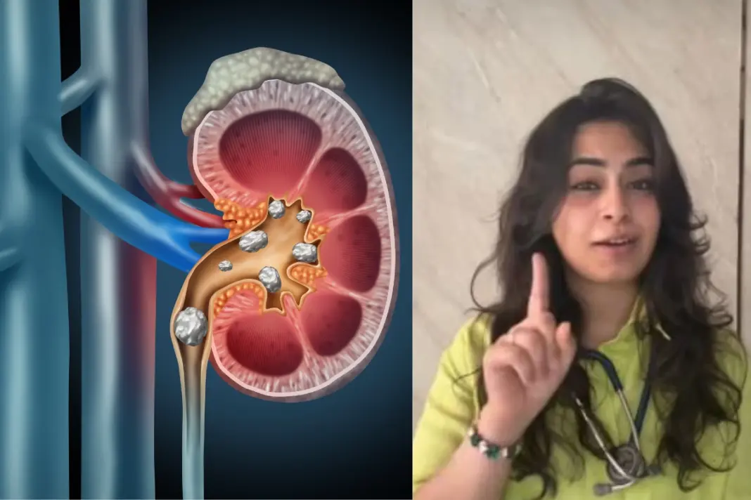 Kidney Stones