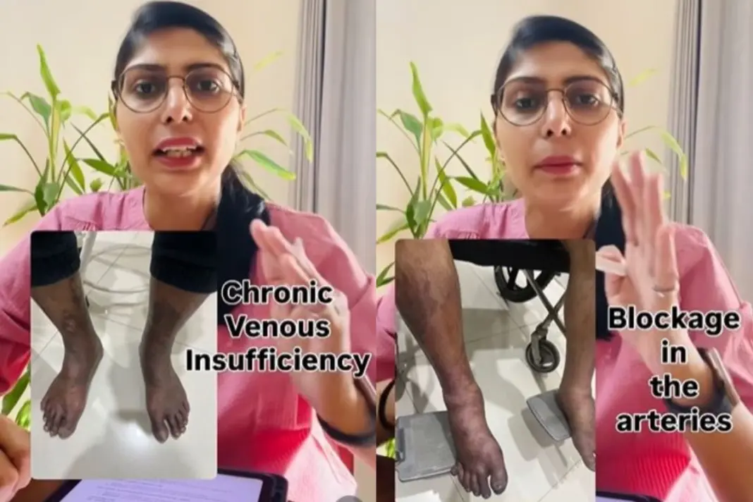 Leg Discoloration AIIMS Doctor Warns This Simple Looking Vein Issue Could Hide A Bigger Health Risk