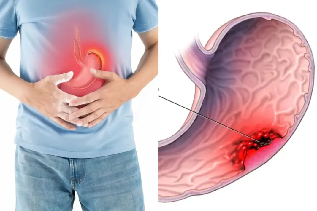 Stomach Cancer